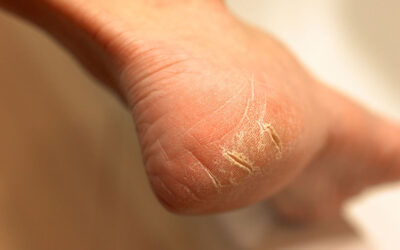 ¿Piel agrietada en las manos y los pies? –